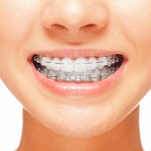 Orthodontic treatments Cheapest braces installation Ajman