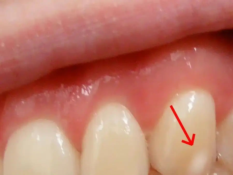 signs of calcium deficiency in teeth in ajman uae