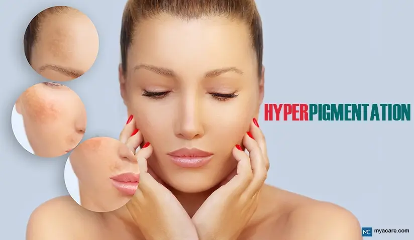 hyperpigmentation treatment Sharjah