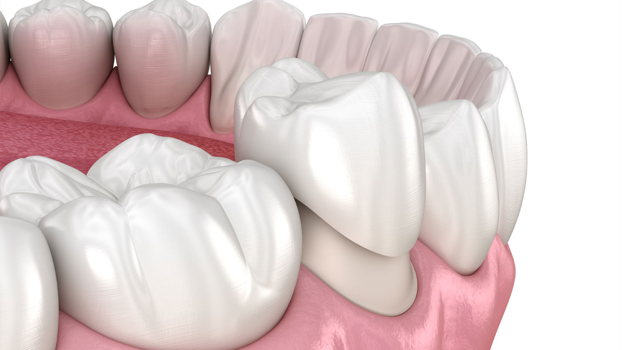 Affordable dental crown replacement Ras Al Khaimah