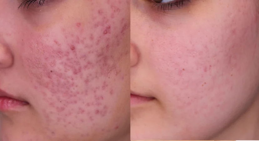 acne scar treatment Ras Al Khaimah