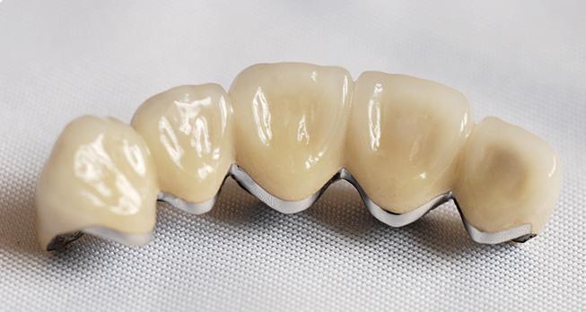 Best ceramic crowns Sharjah