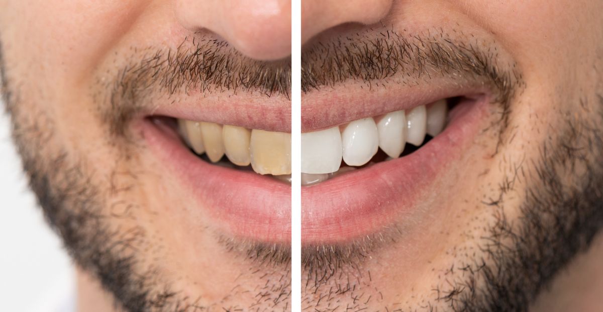 fluoride treatment Umm Al Quwain