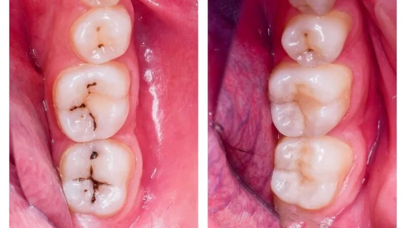 Top composite fillings Sharjah