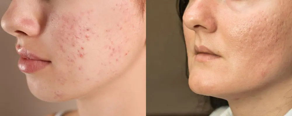 Acne and scars treatments in ajman uae