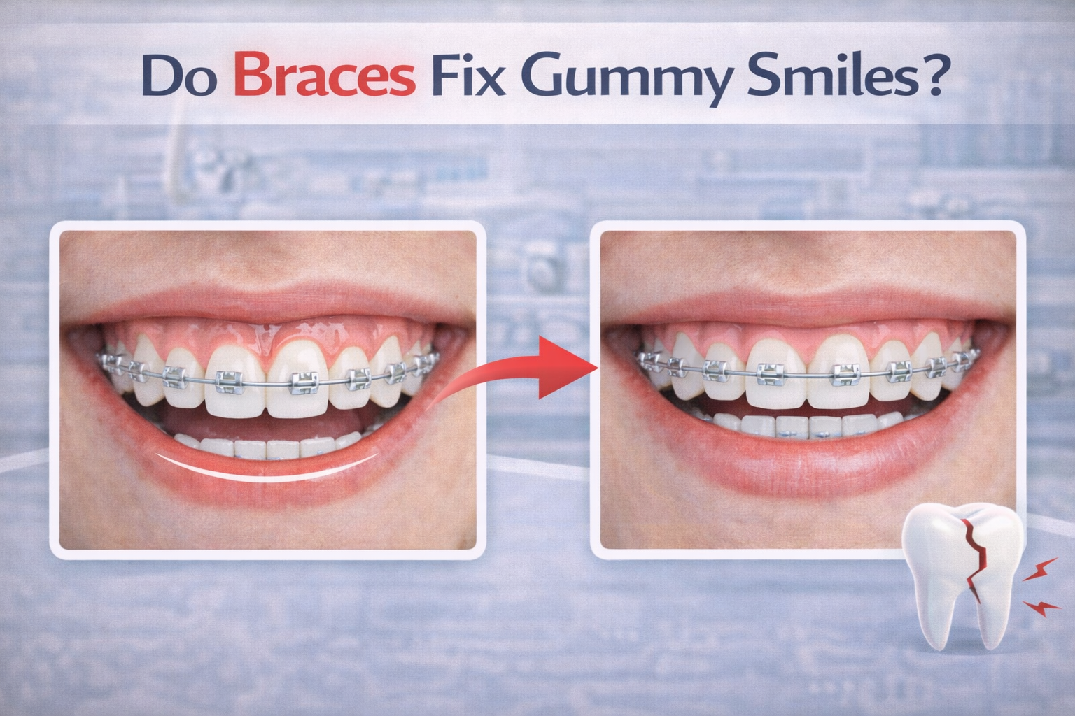 Discover how braces for gummy smile can improve your smile and confidence. Learn about the treatment, process, and benefits for those in UAE.