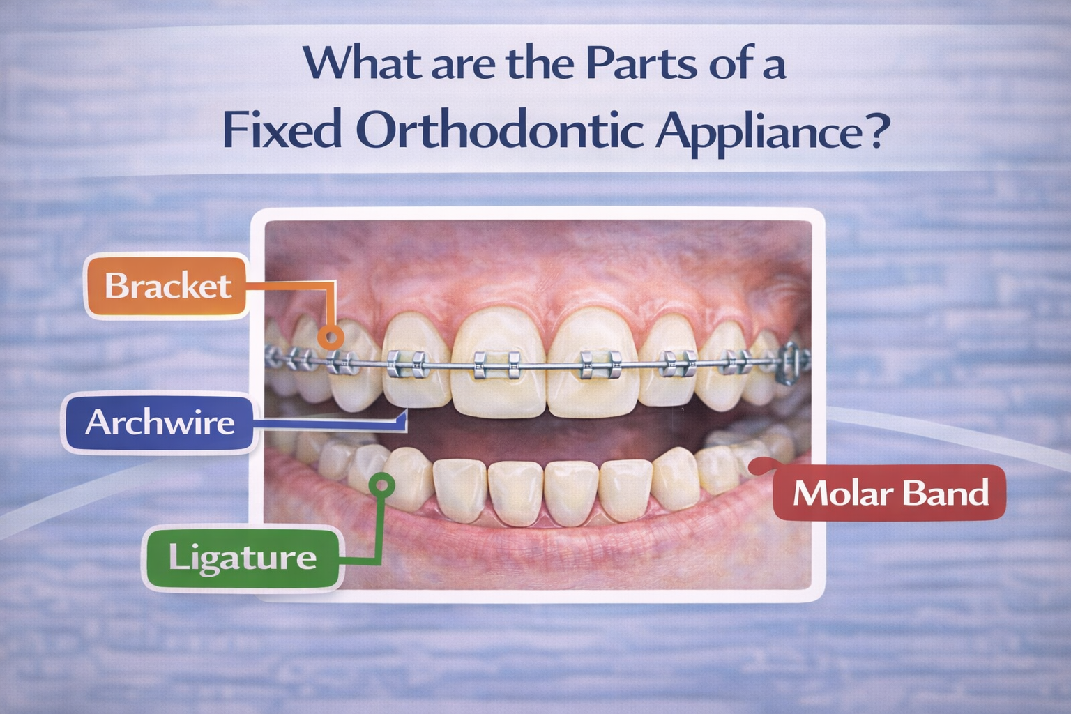 parts of fixed orthodontic appliance