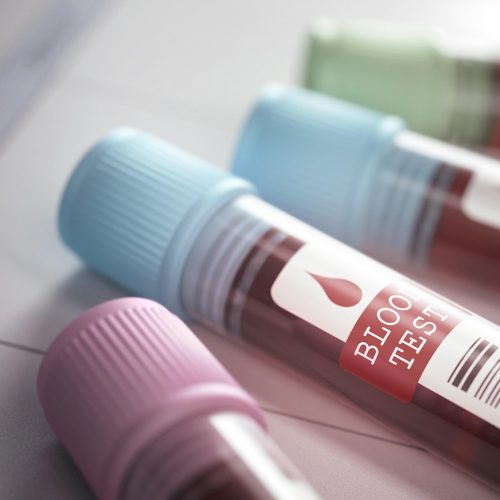 GFETRT Tubes with blood for testing scientific and medical. Depth of field with focus on the Blood Test label.